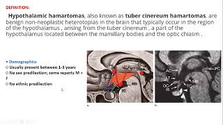 Hypothallamic hamartoma [upl. by Namielus]