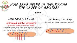 SAAG  SERUM ASCITES ALBUMIN GRADIENT  HARRISON BASED EXPLANATION IN LESS THAN 5 MINUTES [upl. by Magocsi]