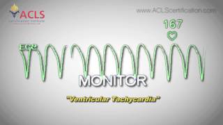 Ventricular Tachycardia by ACLS Certification Institute [upl. by Yenreit]