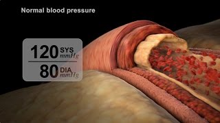 High Blood Pressure Diagnosis  NUCLEUS Medical Media [upl. by Atikihs]