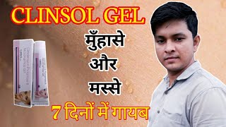 Clinsol gel Use and its side effects  Clinsol gel cream for pimple and wats use in hindi [upl. by Lymann]