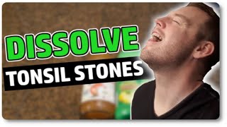 Dissolve Tonsil Stones At Home With Only 3 Ingredients [upl. by Uela993]