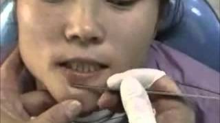 How to scrape the chin for demodex mites [upl. by Halle]