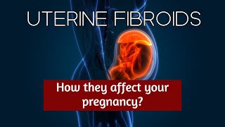 Uterine Fibroid How Do They Affect Your Pregnancy  Antai Hospital [upl. by Ahsened915]