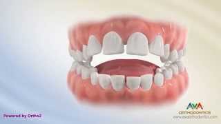 Orthodontic Treatment for Tongue Thrusting Habit  Different Options [upl. by Dnaloy]