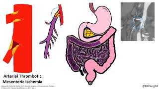 Acute Mesenteric Ischemia [upl. by Eihcra]