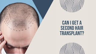 Second Hair Transplant make it a Direct Hair Implantation DHI [upl. by Nnylarak]