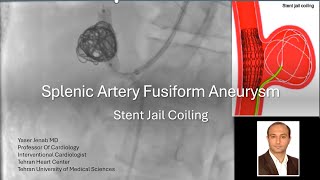 Splenic artery aneurysm stent jail coiling [upl. by Trudy]