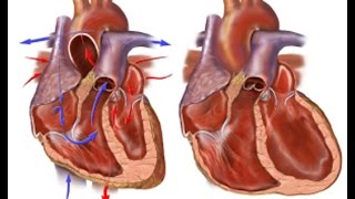 Congestive Heart Failure [upl. by Phyllys]