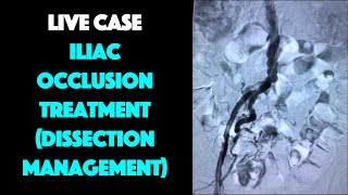 Live Case Aortoiliac Intervention with Dissection Management Discussion [upl. by Herve]