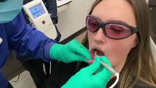 Laser treatment for cold sores and canker sores [upl. by Dannie606]