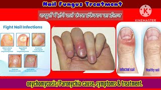 उंगली में सूजनदर्दहोने के कारण व ईलाजparonychianail fungus symptoms amp treatmenthindi [upl. by Necila308]