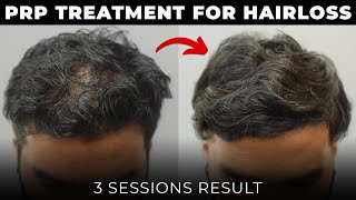 PRP Hair Loss Treatment Results  3 Sessions Result prptreatment [upl. by Pinter]