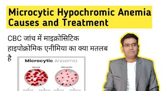 What is Microcytic Hypochromic Anemia its Causes and Treatment in Hindi Iron Deficiency [upl. by Nehttam]