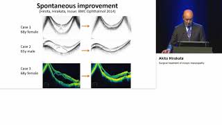 Surgical treatment of myopic maculopathy Hirakata Akito [upl. by Caylor703]