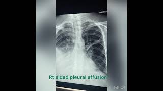 Pleural effusion and aspiration ফুসফুসের নিচে পানি জমা ও বের করা। [upl. by Udella368]