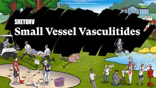 Small Vessel Vasculitides Part 1  Pathophysiology  Sketchy Medical  USMLE Step 1 [upl. by Sibie]