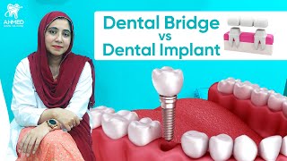 Difference between implant and bridge [upl. by Jayme321]