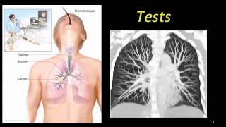 Idiopathic Pulmonary Fibrosis [upl. by Anglim971]