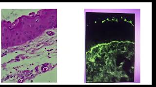 Dr Grossi  Clínica penfigoide ocular Dr Zarate  Patología inmunohistoquímica inmunofluorescencia [upl. by Bat310]