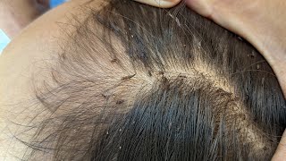 Remove many lice from brown hair  Plucking most of lice from head [upl. by Thorbert71]