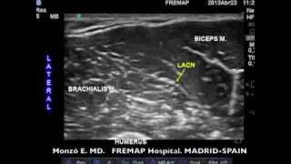 Echoanesthesia Today Lateral Antebrachial Cutaneous Nerve [upl. by Theresa]