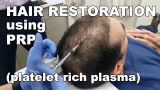 Scalp Hair Restoration using Platelet Rich Plasma  West End Plastic Surgery [upl. by Larisa]