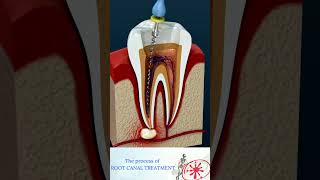 Root Canal Treatment amp Tooth Abscess [upl. by Judith]