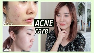 Best treatment for acne scar  Acne Scar treatment  Acne Spots Treatments skincare [upl. by Nedle940]