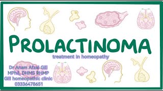 Prolactinomahigh prolactin treatment in homeopathy prolactin onlinehomeopathictreatment [upl. by Navert16]