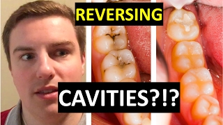 CAN YOU CURE CAVITIES AT HOME [upl. by Lefton299]