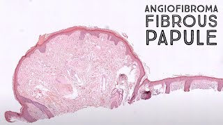 Angiofibroma fibrous papule clinical mimic of basal cell carcinoma pathology dermatology [upl. by Eiramana]