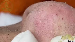 Loan Nguyen Acne Treatment 00037 [upl. by Lecroy]