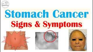 Stomach Cancer Signs and Symptoms  Clinical Manifestations of Gastric Cancer [upl. by Annoirb377]