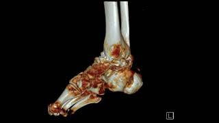 Ankle severe osteoarthritis [upl. by Prentice]