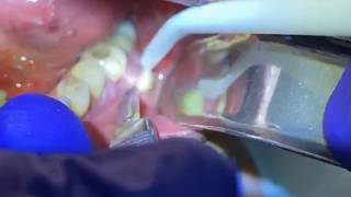 Draining a Dental Abscess  Advanced Dental Care [upl. by Stephani]