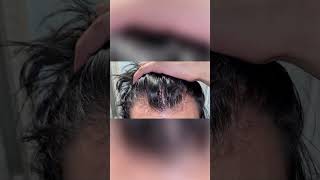 Finasteride results finasteride hairlosstreatment hair hairlosscure hairloss [upl. by Jar]