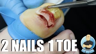 UNBELIEVABLE FUSED TOENAIL REMOVAL [upl. by Ravahs]