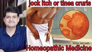 Jock itch  fungal infection  Homeopathic Medicine for tinea cruris  explain [upl. by Trbor]