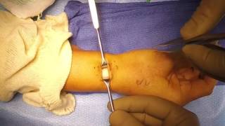 First Extensor Compartment Release for deQuervains Tenosynovitis [upl. by Lesirg]