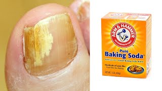 How to get rid of toenail fungus naturally fast in 2 day with baking soda  Nail fungus treatment [upl. by Helgeson]