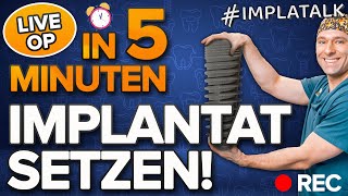 So wird ein ZAHNIMPLANTAT in 5 Minuten eingesetzt ✅ Alle Schritte einfach erklärt [upl. by Publus]