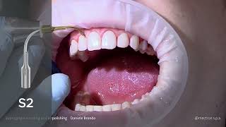 PROPHYLAXIS  CASE REPORT  Supragingival scaling and airpolishing Dr Daniele Brondo [upl. by Nivrehs641]