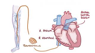 Pulmonary Embolisms causes symptoms diagnosis treatment pathology [upl. by Ibed]