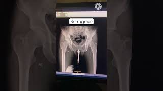 Xray  fluoroscopy procedure  Retrograde urethrogram procedure  camel dance radiology retrograde [upl. by Nie82]