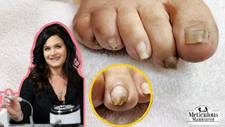 👣How to Fix a Pincer Big Toenail with Acrylic Journey👣 [upl. by Ycats886]