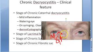 Ophthalmology 402 a Chronic DaCryoCystitis catarrhal mucocele suppurative fibrotic [upl. by Bunting]