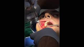 Oro Antral fistula Repair using Buccal advancement Flap amp Buccal fat Flap [upl. by Banebrudge220]