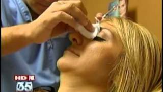 Dr Roger Bassin uses Restylane for Non Surgical Nose Job [upl. by Ancalin]