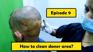 How to clean donner area after hair transplant  Episode 9  Hair Transplant Journey [upl. by Tierney]